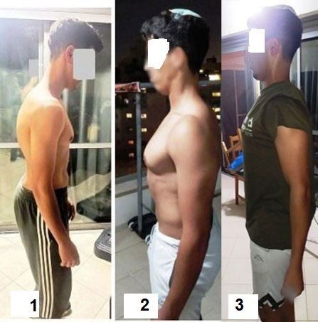 יישור-גב-כפוף-טיפול-קיפוזיס-שוירמן-פיזיותרפיה-תוספת-גובה שלבים (בעיצומו של...) טיפול בקיפוזיס מבני/ שוירמן קיפוזיס אצל נער בן 19. ניתן לשים לב בבירור לשינוי הדרמטי במנח עמוד השדרה על הסגמנטים השונים שלו, נוסף על מנח הכתפיים, שכמות וכמובן, תוספת גובה נאה, כל אלה בכלי טיפול חדשניים, שיטת פאר היציבה (Adaptive-Load)