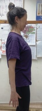 יציבה נכונה בעמידה, גב זקוף עם חזה מורם, סנטר אסוף, מנח שכמות וכתפיים תקין. כל אלה הושגו לאחר טיפול בקיפוזיס אצל אישה בת 36 בשיטתנו, שיטת 'פאר היציבה' (Adaptive-Load).